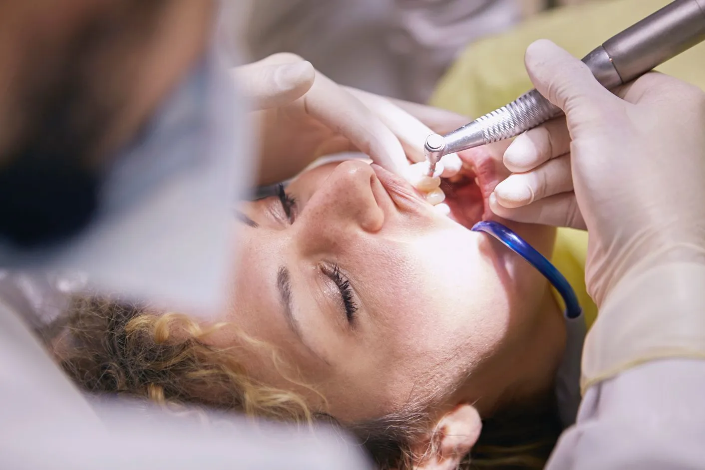 Teeth Cleaning in Al Ain